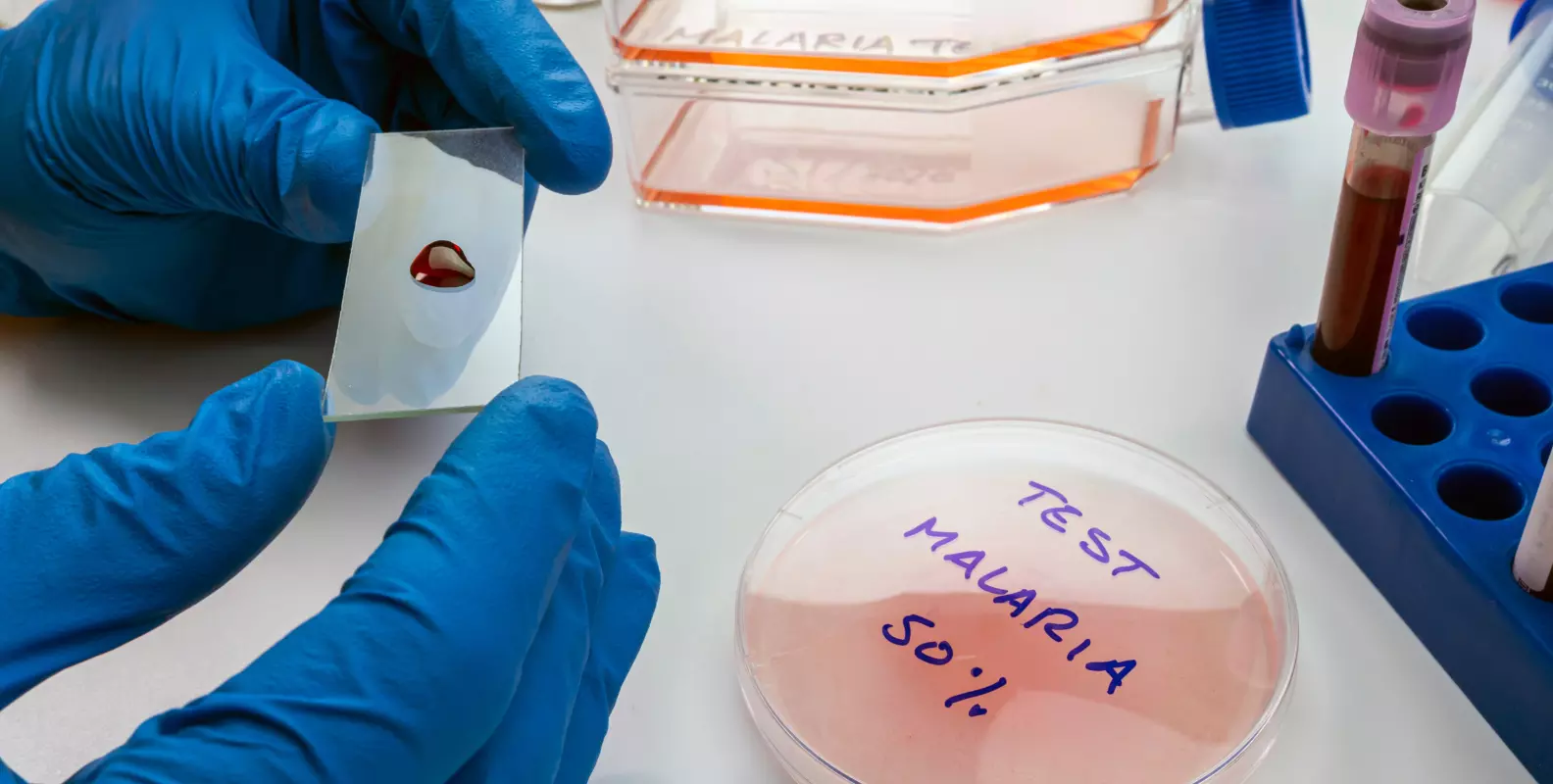 Scientist Examines Blood Sample from Sick Person with Malaria
